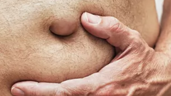 En adultos, el ombligo puede reabrirse con una hernia umbilical: ¿cómo prevenirlo?