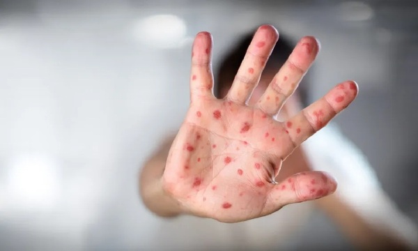 Reino Unido detecta nueva cepa recombinante de mpox en un viajero procedente de Asia - OviedoPress