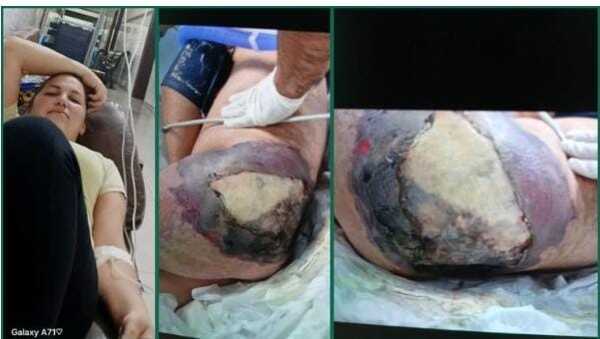 Popular / Denuncian que inyección perforó vaso de joven de 19 años y la mandó al otro mundo