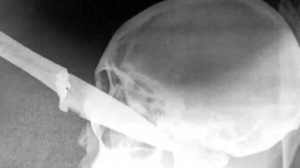 Tras ronda de tragos, ligó un cuchillo en el ojo