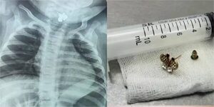 Popular / ¡Dionoguarde! Beba de diez meses tragó un arito