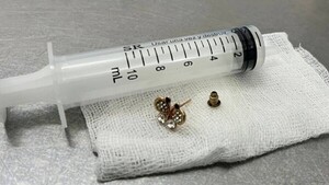 Beba de 10 meses se tragó un arito y fue salvada de milagro en el INERAM