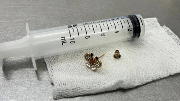 Beba de 10 meses se tragó un arito y fue salvada de milagro en el INERAM