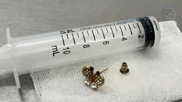 Una bebé de 10 meses aspiró un arito y 5 días después se percataron del hecho, fue intervenida en el Ineram