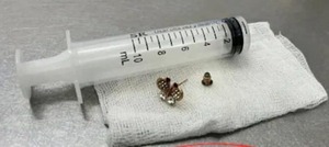 Una bebé de 10 meses tragó un arito y fue intervenida en el Ineram