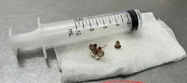 Una bebé de 10 meses tragó un arito y fue intervenida en el Ineram