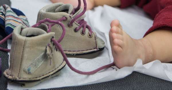 Diario HOY | Pie Bot, una malformación que tiene solución con tratamiento temprano