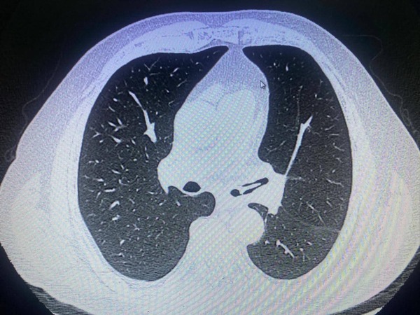 Popular / Karai ijahy’o pa’ ã con hueso de pollo y tuvo que ser operado