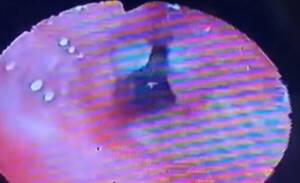 ¿Mba'e piko? Tenía hueso de pollo en el pulmón hace 6 meses