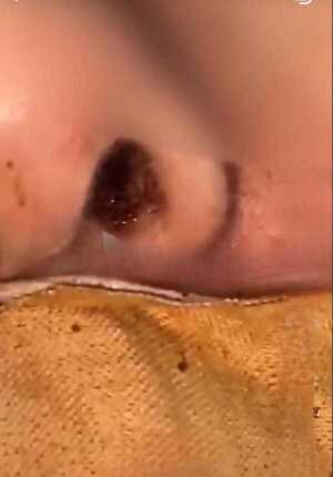 Popular / Doñita internada en UTI de IPS Ingavi oreko larvas en la nariz