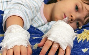 El 60% de los pacientes quemados son niños