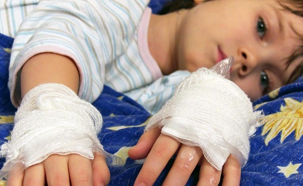 El 60% de los pacientes quemados son niños