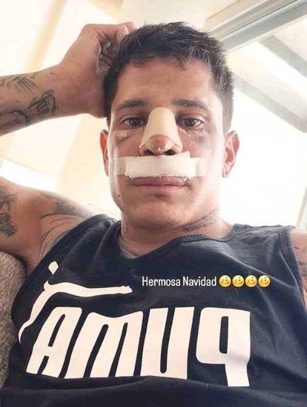 ¡Novaserrr! Itu se hizo la cirugía de la nariz