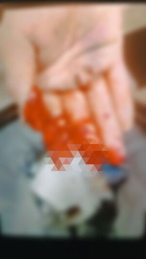 Cebollón dejó a adolescente sin dos dedos tras detonar en plena fiesta navideña en Concepción - Concepción al Día