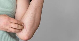 Sarpullido, afección de la piel más frecuente en épocas de calor