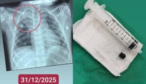 Extraen tapita de bolígrafo del pulmón de un niño de 3 años | Unicanal