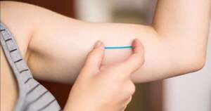 La Nación / Implante subdérmico: método anticonceptivo más utilizado