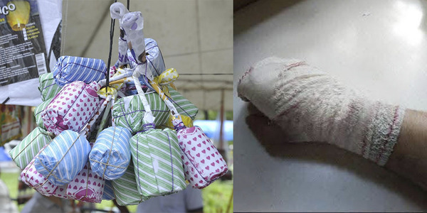 ALTO PARANÁ: HOMBRE PIERDE LA MANO POR LA EXPLOSIÓN DE UN POTENTE PETARDO