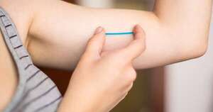 La Nación / Implante subdérmico, el método anticonceptivo más utilizado en Paraguay