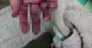 La Nación / Explosión de petardos deja 3 niños heridos, entre ellos una beba de 5 meses en estado grave