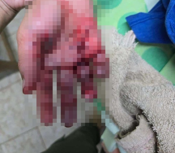 UNA BEBÉ DE 5 MESES RESULTÓ GRAVEMENTE HERIDA TRAS EXPLOSIÓN DE PETARDO