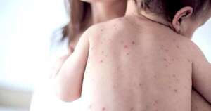 Diario HOY | Sin nuevos casos, Paraguay cerró el 2025 sin sarampión