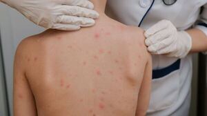 Vigilancia de la Salud reporta control del sarampión a nivel nacional - ADN Digital