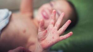 Sin nuevos casos, Paraguay cerró el año sin sarampión