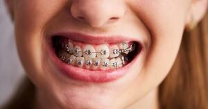 Diario HOY | Bráquets, una adaptación del extranjerismo brackets