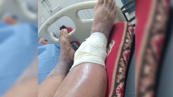 Llegó a IPS con gusanos en la pierna y solo le pusieron vaselina