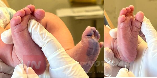 TEST DEL PIECITO FORTALECE LA ATENCIÓN NEONATAL EN ITAPÚA