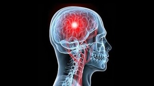 ACV: claves para entender una amenaza silenciosa y prevenible - Portal Digital Cáritas Universidad Católica