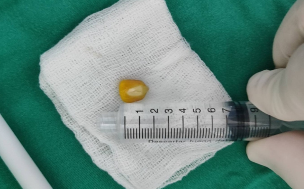 Niño de 4 años sufre asfixia por un maíz, pero es salvado a tiempo en el INERAM