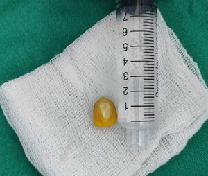 Niño de 4 años se asfixió con granos de maíz y fue salvado a tiempo en el INERÁN