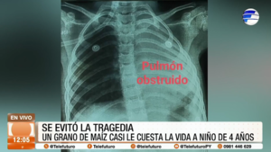 Médicos salvan a un niño que aspiró un grano de maíz