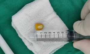 Rápida derivación y trabajo médico salvan la vida de un niño asfixiado en Quiindy - OviedoPress