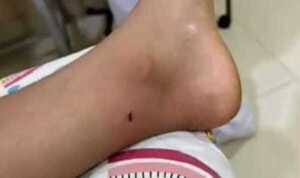 Popular / Emiten alerta por picaduras de rayas en playas Encarnación