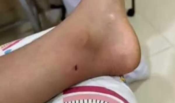 Popular / Emiten alerta por picaduras de rayas en playas Encarnación