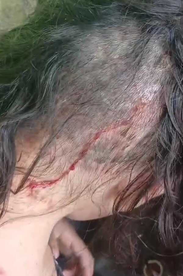 Popular / Niña rescatada con la cabeza repleta de gusanos