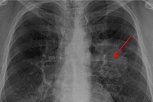 Aumentan casos de cáncer de pulmón: expertos llaman a revisión inmediata