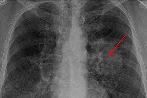 Aumentan casos de cáncer de pulmón: expertos llaman a revisión inmediata