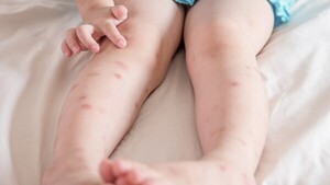 Confirman que niño de tres años tiene leishmaniasis