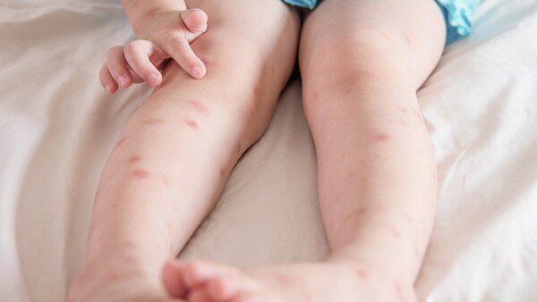 Confirman que niño de tres años tiene leishmaniasis