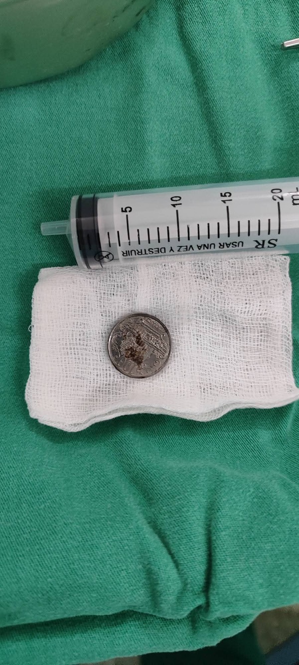 Popular / Mitakuña'i tragó una moneda de 100 y se salvó de milagro