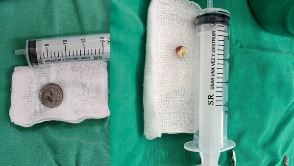 Niño tragó moneda y otro bebé aspiró maní