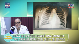 Rápida intervención médica salva a niña de tres años que tragó una moneda