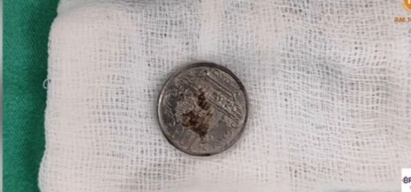 Médicos del INERAM extraen moneda del esófago de una niña