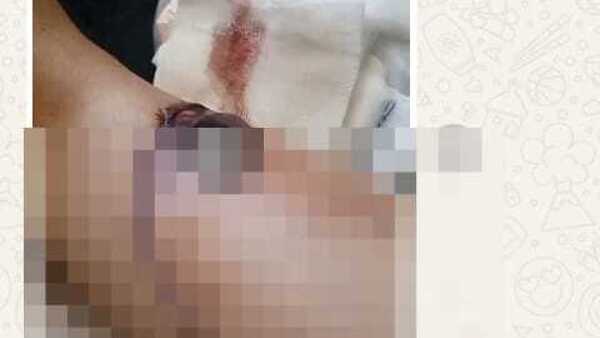 Cayó al cruzar un puente y le dejó una feroz herida en la pierna anga