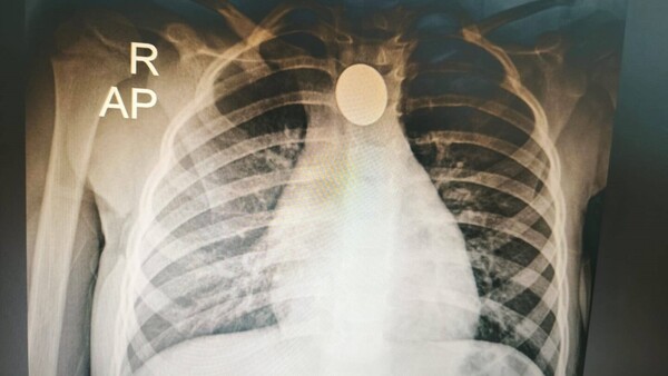 Médicos del Ineram salvan la vida a una niña de tres años que tragó una moneda