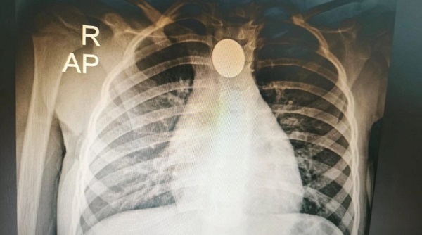 Exitosa extracción de moneda a niña de tres años en Ineram